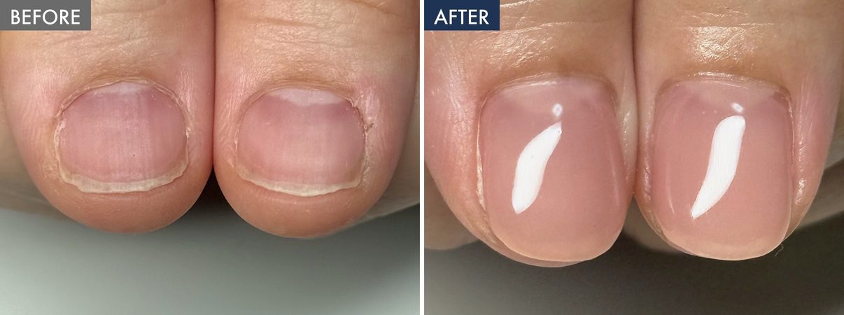 薄く小さく見える親指の爪と、パラジェルで仕上げた後の爪
